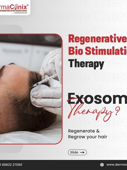 Another view of the Exosome therapy procedure, a non-surgical way to regenerate and regrow your hair.