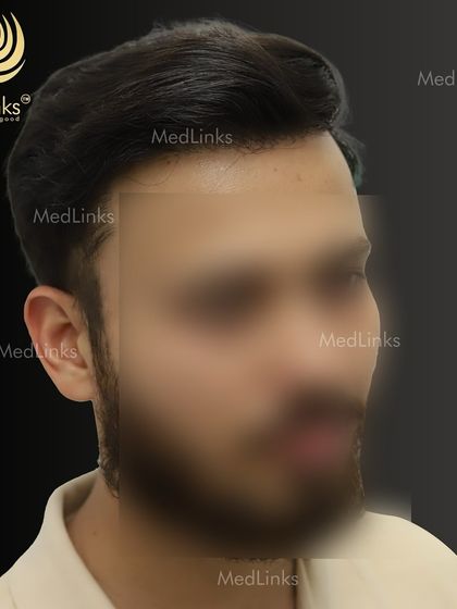 The final result from the side, showing a natural and full hairline.