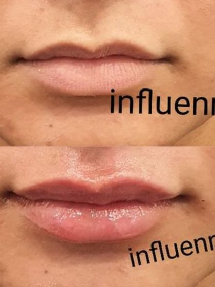 A classic before and after of a lip filler treatment, showcasing enhanced volume and a beautifully defined cupid's bow.