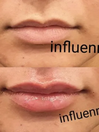 A classic before and after of a lip filler treatment, showcasing enhanced volume and a beautifully defined cupid's bow.