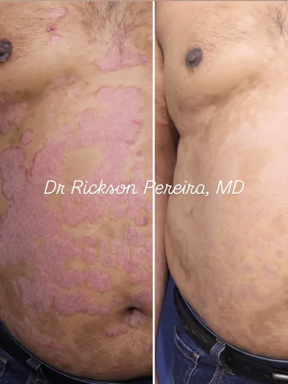 This is the power of evidence-based medicine. This patient lived with severe psoriasis for 17 years, trying various alternative therapies with no success. Using a modern biologic therapy, we achieved near-complete skin clearance in just two weeks, restoring not just his skin but his confidence and quality of life.