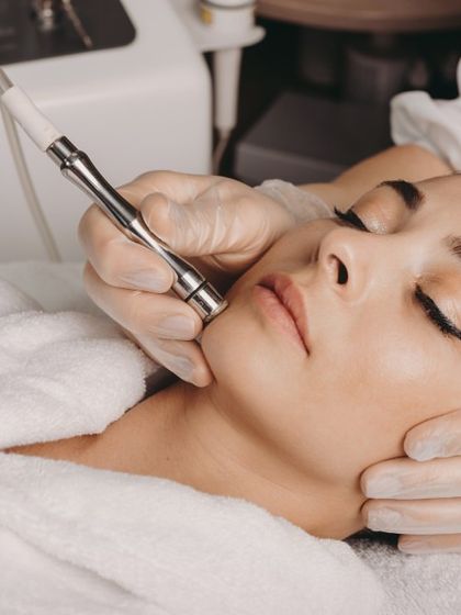 This image shows a microdermabrasion treatment, which I use to improve skin texture, unclog pores, and reduce mild pigmentation. It leaves the skin feeling silky smooth and rejuvenated.