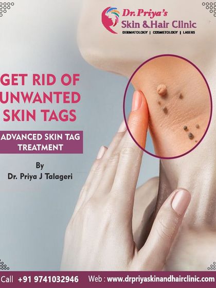 Priya J Talageri - Laser Tattoo & Blemish Removal Blemish, Mole, and Tag Removal photo 5