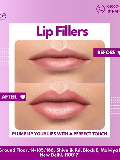 Plump up your lips with a perfect touch. This before and after image showcases the subtle yet impactful results of our lip filler service, available at our Malviya Nagar clinic.