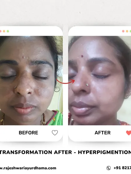 This before and after image shows the significant reduction of hyperpigmentation on the face. My customized Ayurvedic cosmetology treatments target dark spots and melasma, using herbal formulations to restore even skin tone and natural radiance without harsh chemicals.