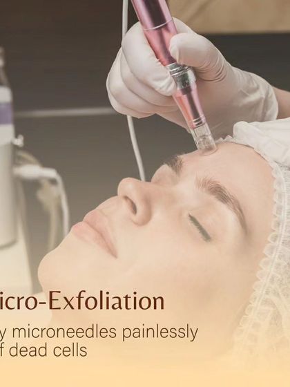 The first step in a Dermafrac facial is micro-exfoliation. Tiny, painless microneedles are used to gently buff away dead cells from the skin's surface, preparing it for serum infusion.