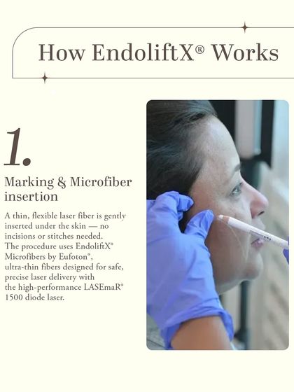 The first step of the EndoliftX procedure involves precise marking and the gentle insertion of a thin, flexible laser microfiber under the skin. No incisions or stitches are needed, as the LASEmaR 1500 diode laser is delivered with pinpoint accuracy.