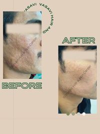 Acne & Scar Treatment