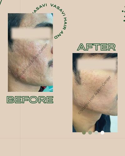 Acne & Scar Treatment