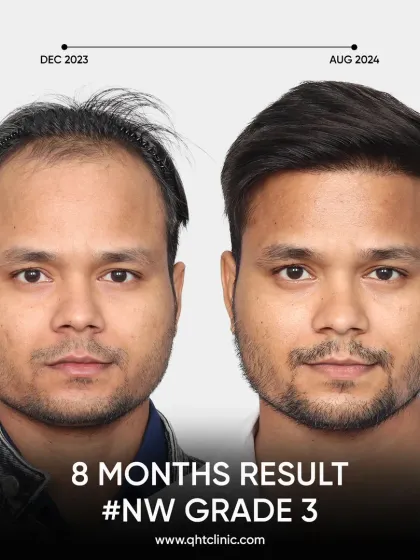 An 8-month result for a Norwood Grade 3 patient. We recreated his hairline and frontal region with 3100 grafts for a remarkable new look.