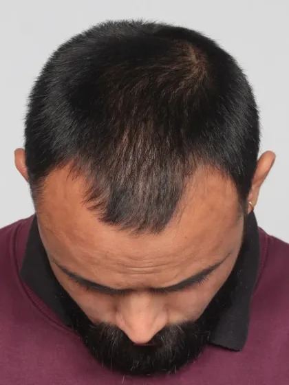 A stunning 12-month transformation for a Grade 3 baldness case. We used 3000 grafts for a personalized hairline, temple reconstruction, and dense frontal coverage.