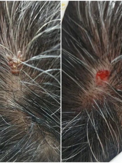 Here is a close-up before-and-after view of a viral wart removal from the scalp. Notice how the raised, textured wart is completely gone, leaving a clean surface that will heal without scarring. This is a common treatment we perform with high success.