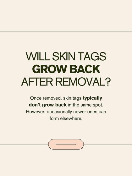Will skin tags grow back after removal? Typically, they do not grow back in the same spot. However, new ones can occasionally form elsewhere, especially if you are prone to them.