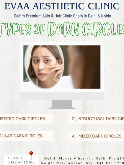 Understanding the type of dark circle is key to effective treatment. This graphic explains the different classifications, including pigmented, structural, vascular, and mixed types.