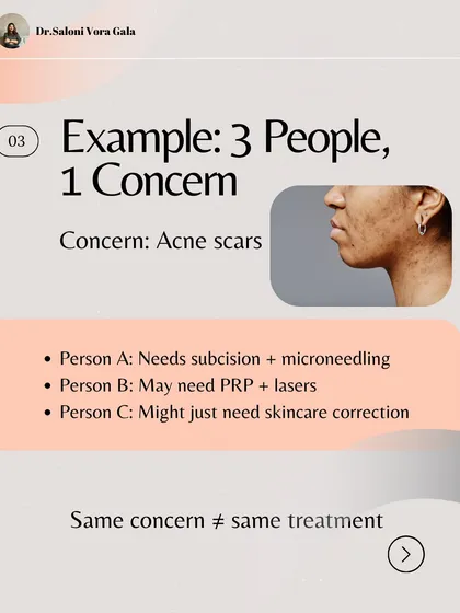 This example shows why personalized treatment is so important. Three people can have the same concern, like acne scars, but require completely different treatment plans. What you see online is not a one-size-fits-all solution.