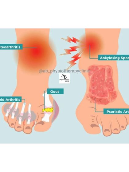 Arthritis can affect the feet in many ways, from osteoarthritis in the big toe to rheumatoid arthritis in multiple joints. We help manage the pain and maintain mobility.