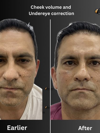 A frontal view of the same patient, showing the significant improvement in both the under-eye area and cheek volume. This comprehensive approach creates a very natural and balanced result.