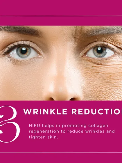 Wrinkle reduction is another key benefit of HIFU. By promoting collagen regeneration, the treatment helps to smooth out fine lines and wrinkles, giving the skin a plumper and more refreshed appearance.