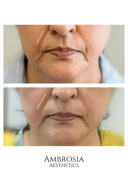 This before-and-after shows the correction of under-eye hollows and a subtle lip enhancement. Addressing the tear troughs with filler instantly made the patient look more awake and vibrant.