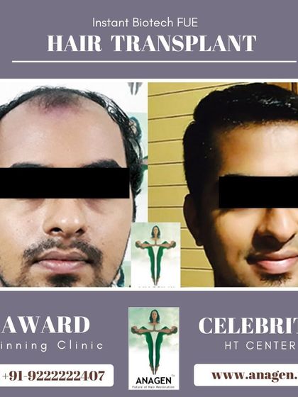 An excellent result from our Instant Biotech FUE hair transplant. The patient's transformation is remarkable, with a full and healthy looking head of hair.