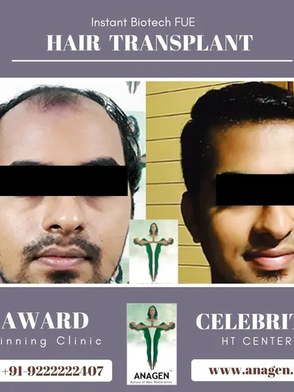 An excellent result from our Instant Biotech FUE hair transplant. The patient's transformation is remarkable, with a full and healthy looking head of hair.