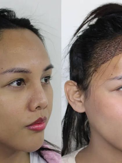 This side view shows how the new hairline will frame her face more effectively once the hair grows in.