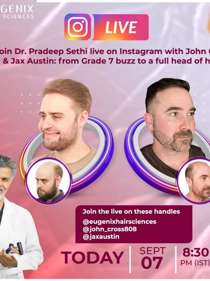 Announcing an Instagram Live session with two of our international patients, John Cross and Jax Austin. They shared their incredible journeys, from Grade 7 baldness to a full head of hair, inspiring many others.