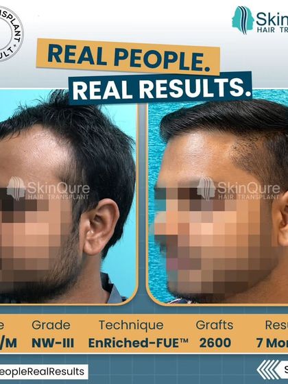Another angle of the 24-year-old patient's 7-month result. This view highlights the density achieved in the temple area, which is crucial for a balanced and youthful appearance.