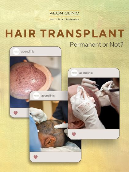 So, is a hair transplant permanent? This series of posts explains what to expect in the long term.