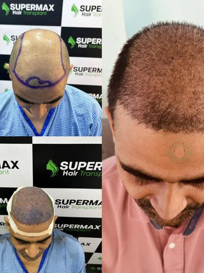 The 10th-day transformation. You can see the scabs falling off and the new grafts setting in, ready to grow.