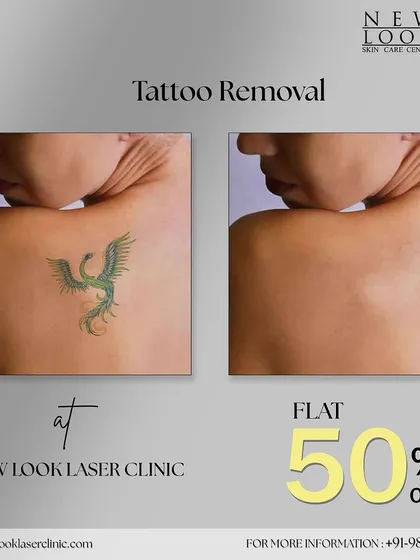 This before and after image shows the significant fading of a green ink phoenix tattoo. Our process is effective on a wide range of ink colors, helping you achieve clear, rejuvenated skin.