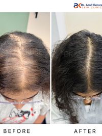 Non-Surgical Hair Loss Treatment