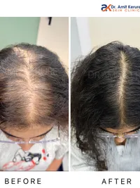 Non-Surgical Hair Loss Treatment