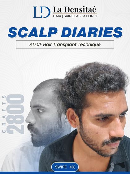 This "Scalp Diaries" post for Nikhil Jankar highlights the 2,800 grafts that transformed his look. His journey is a great example of how a well-planned procedure can restore a natural, dense hairline.