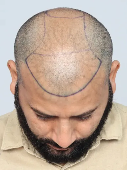 This shows the crucial first step: hairline design. We mark the area precisely to ensure the final result perfectly frames the face.