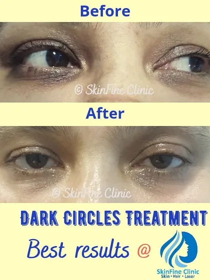 Here you can see the visible improvement in under eye dark circles. This result was achieved through a combination of gentle, targeted chemical peels and specialized creams designed to reduce periorbital pigmentation and improve blood circulation in the delicate eye area.