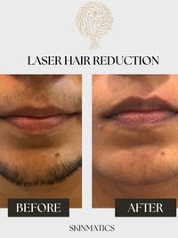 Laser Hair Reduction