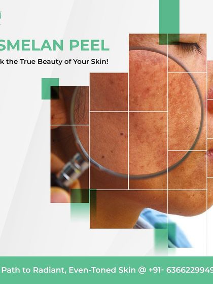 Struggling with melasma or photodamage? The Cosmelan peel is the leading worldwide depigmentation method, backed by a proven homecare plan to treat even the most stubborn skin spots with maximum efficiency and safety.