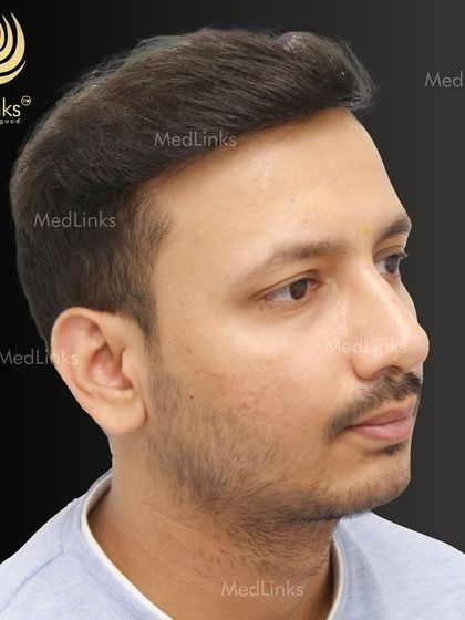 The final result from the side, showing a natural and dense hairline.