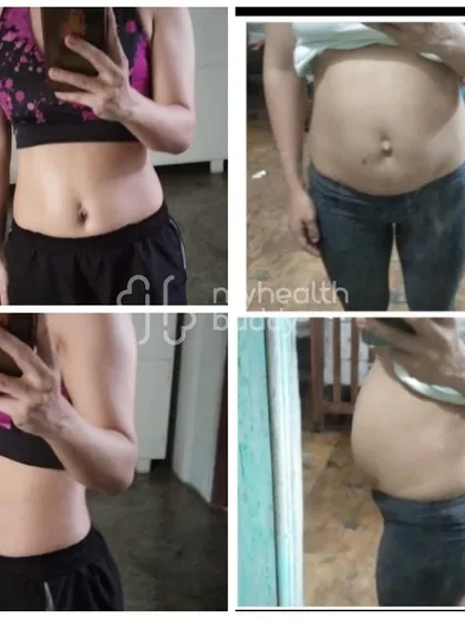Healing Diastasis Recti (the separation of abdominal muscles post-pregnancy) is a specific goal for many new mothers I work with. This client's progress shows how targeted core exercises can effectively close the gap and rebuild core strength.