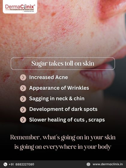A list of the negative effects sugar can have on your skin, including increased acne, wrinkles, sagging, and the development of dark spots. What happens in your skin reflects your overall body health.