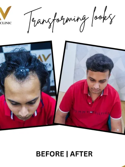 Here we focused on rebuilding the frontal hairline and adding density behind it. The after photo shows a natural, well-defined hairline that perfectly frames his face.