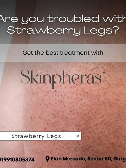 Strawberry legs are a common concern we effectively treat. By using Alma Soprano laser technology, we target hair at the root, preventing the clogged pores and ingrowns that cause the dotted appearance.