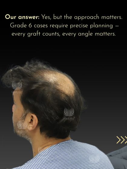 Our answer was yes, but it required precise planning. This image shows the extent of his hair loss from the side.
