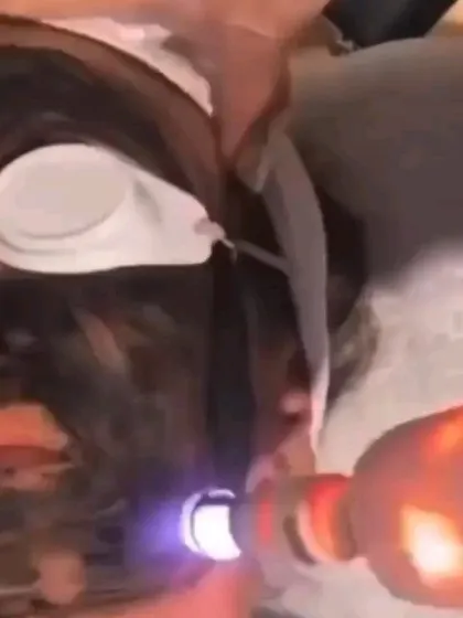 This image captures the moment a carbon laser peel is performed. The laser interacts with the carbon lotion to create a peeling effect that removes dead skin cells, clears clogged pores, and treats acne and pigmentation for brighter skin.