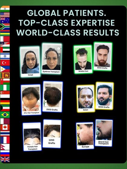 This collage showcases our results with patients from around the globe, including Israel, the Middle East, and Europe. We offer a range of services, from afro hair transplants to beard transplants.