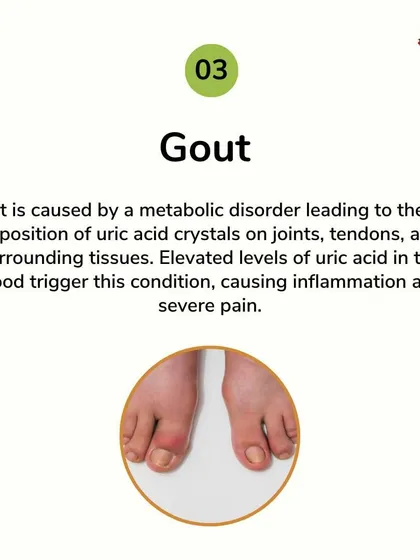 Gout is a painful condition caused by uric acid crystal deposits in the joints. I use a combination of diet, herbs, and therapies to manage the underlying metabolic disorder, reducing inflammation and preventing future flare-ups.