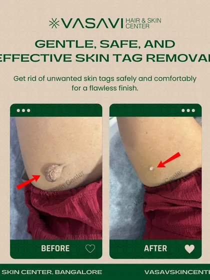 Here you can see a clear before-and-after of a skin tag removal from the underarm area. The procedure is quick, minimally invasive, and the final result is smooth, clear skin with no trace of the previous growth.