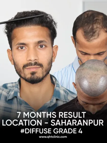 From Diffuse Grade 4 to a natural look in just 7 months. We used 4200 grafts to re-densify the frontal and crown regions.