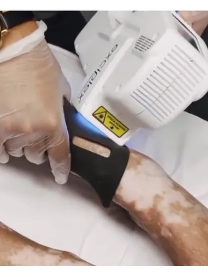 This is the Excimer laser, a highly targeted form of phototherapy I use for treating conditions like vitiligo. It delivers a precise beam of UVB light to stimulate repigmentation only in the affected areas, protecting the surrounding healthy skin. It represents my commitment to using advanced, FDA-approved technology for safe and effective results.